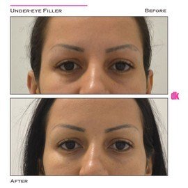 FILLER - Under - Eye - Before and After