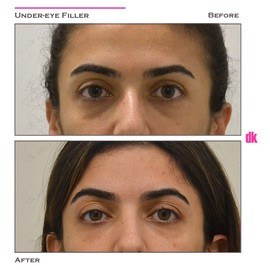 FILLER - Under - Eye - Before and After