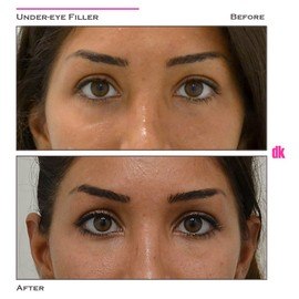 FILLER - Under - Eye - Before and After