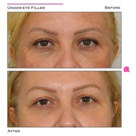 FILLER - Under - Eye - Before and After