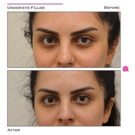 FILLER - Under - Eye - Before and After