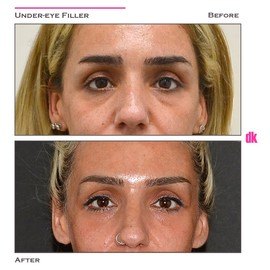 FILLER - Under - Eye - Before and After