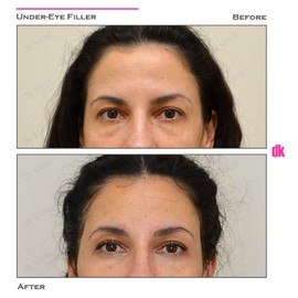 FILLER - Under - Eye - Before and After