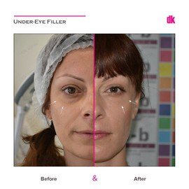 FILLER - Under - Eye - Before and After