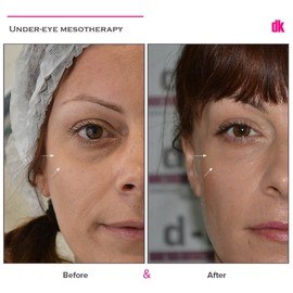 FILLER - Under - Eye - Before and After