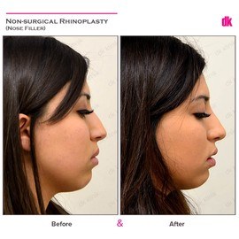 FILLER- Nose - Before and After