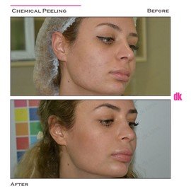 CHEMICAL PEELING - Before and After