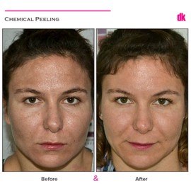CHEMICAL PEELING - Before and After