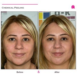 CHEMICAL PEELING - Before and After