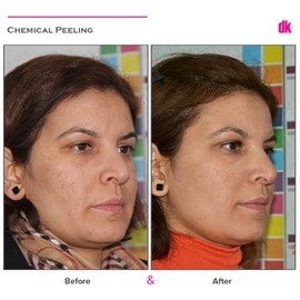 CHEMICAL PEELING - Before and After