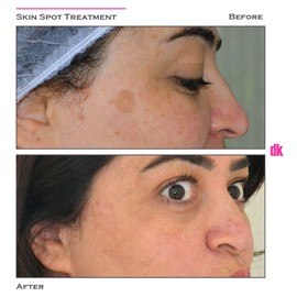 CHEMICAL PEELING - Before and After