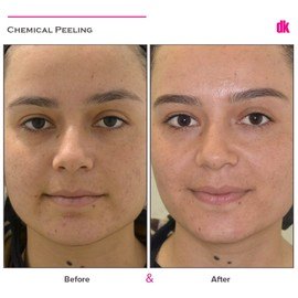 CHEMICAL PEELING - Before and After