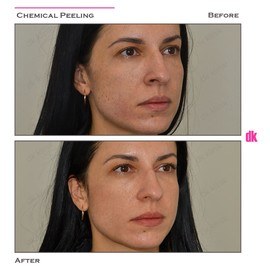 CHEMICAL PEELING - Before and After