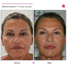 MESOTHERAPY - Before and After