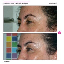MESOTHERAPY - Before and After