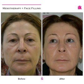 MESOTHERAPY - Before and After