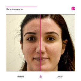 MESOTHERAPY - Before and After