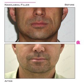 FILLER - Male - Before and After