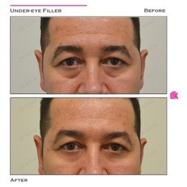 FILLER - Male - Before and After