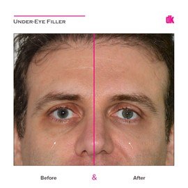 FILLER - Male - Before and After