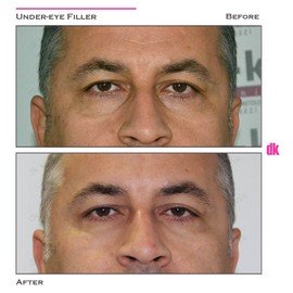 FILLER - Male - Before and After