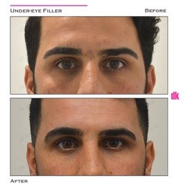 FILLER - Male - Before and After
