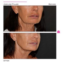 FILLER- Jawline - Before and After
