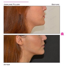 FILLER- Jawline - Before and After