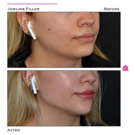FILLER- Jawline - Before and After