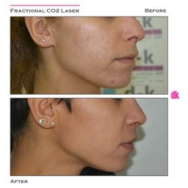 FRACTIONAL CO2 LASER - Before and After