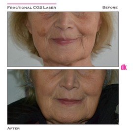 FRACTIONAL CO2 LASER - Before and After