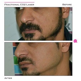FRACTIONAL CO2 LASER - Before and After