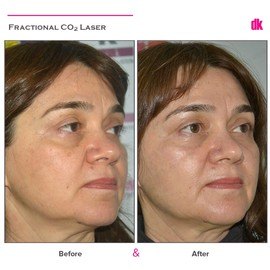 FRACTIONAL CO2 LASER - Before and After