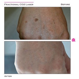 FRACTIONAL CO2 LASER - Before and After