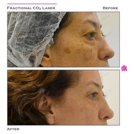 FRACTIONAL CO2 LASER - Before and After