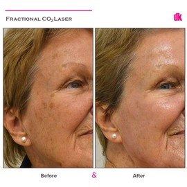 FRACTIONAL CO2 LASER - Before and After
