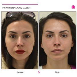 FRACTIONAL CO2 LASER - Before and After