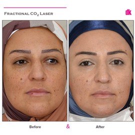 FRACTIONAL CO2 LASER - Before and After