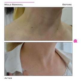 MOLE REMOVAL - Before and After