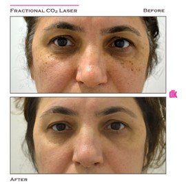 MOLE REMOVAL - Before and After