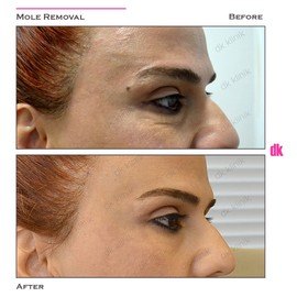 MOLE REMOVAL - Before and After