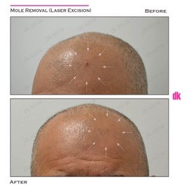 MOLE REMOVAL - Before and After