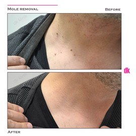 MOLE REMOVAL - Before and After