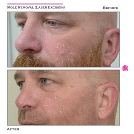 MOLE REMOVAL - Before and After
