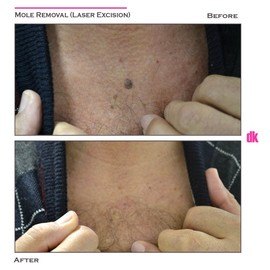 MOLE REMOVAL - Before and After