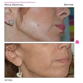 MOLE REMOVAL - Before and After