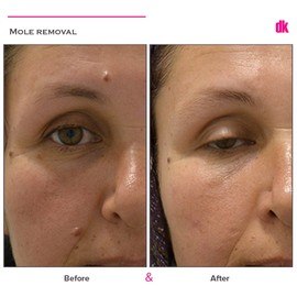 MOLE REMOVAL - Before and After