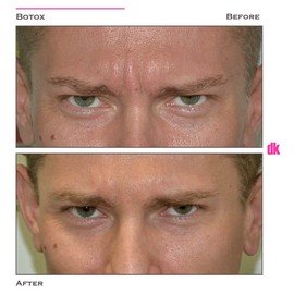 BOTOX - Man - Before and After