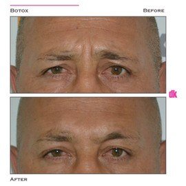 BOTOX - Man - Before and After