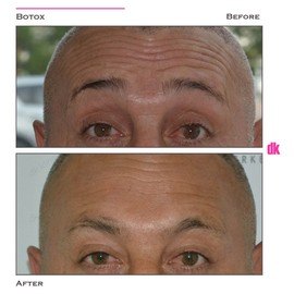 BOTOX - Man - Before and After